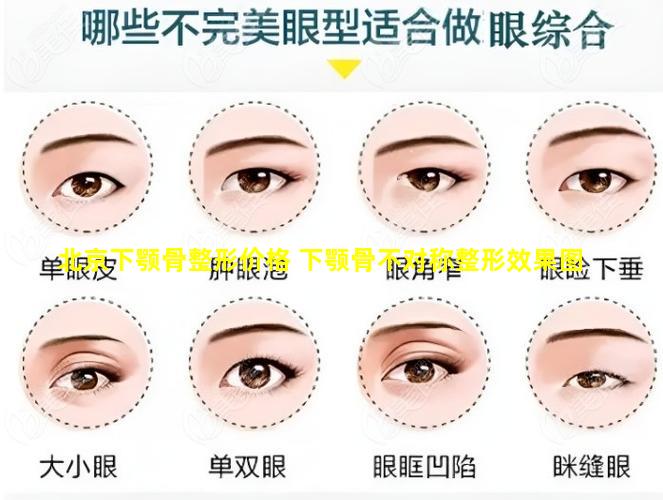北京下颚骨整形价格 下颚骨不对称整形效果图